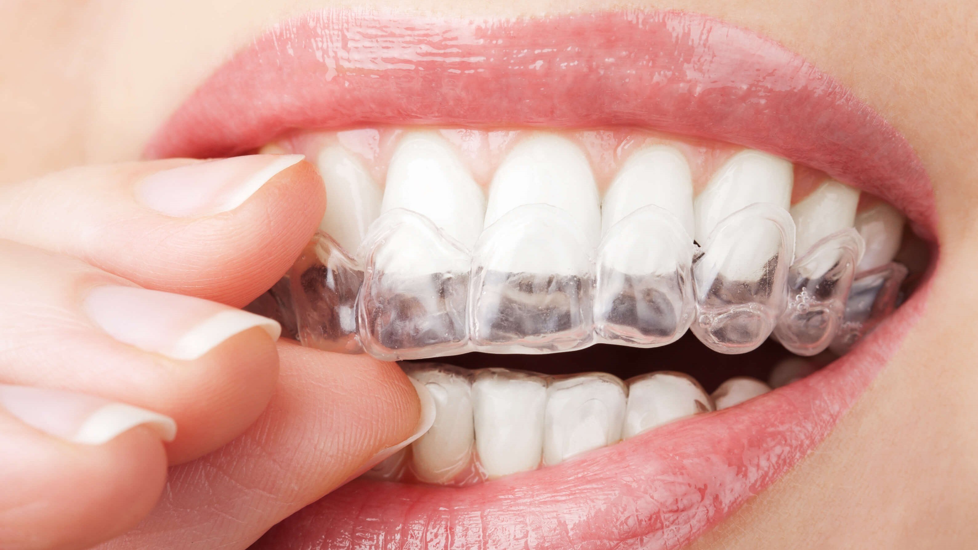 Does Invisalign Work With Crowns and Bridges?
