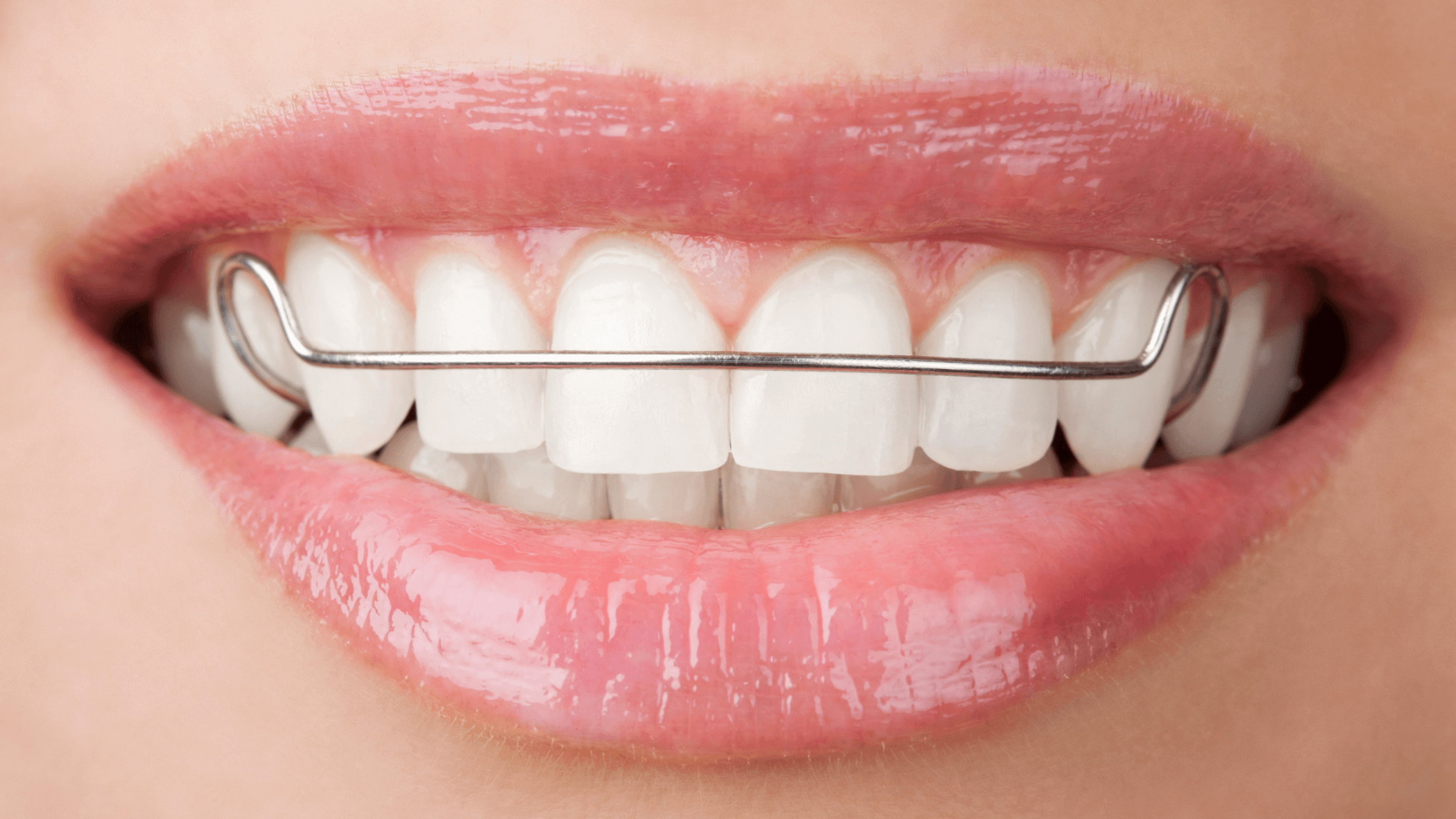 What If I Don't Wear a Retainer After Braces Come Off? - Medland  Orthodontics