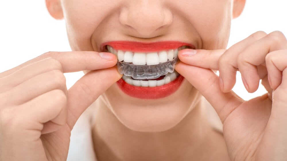How Does The Invisalign Process Work?