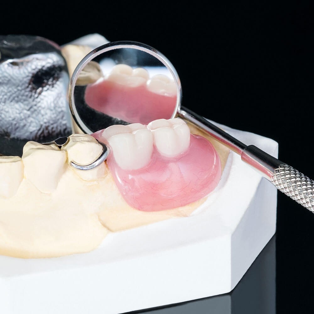 Partial Dentures