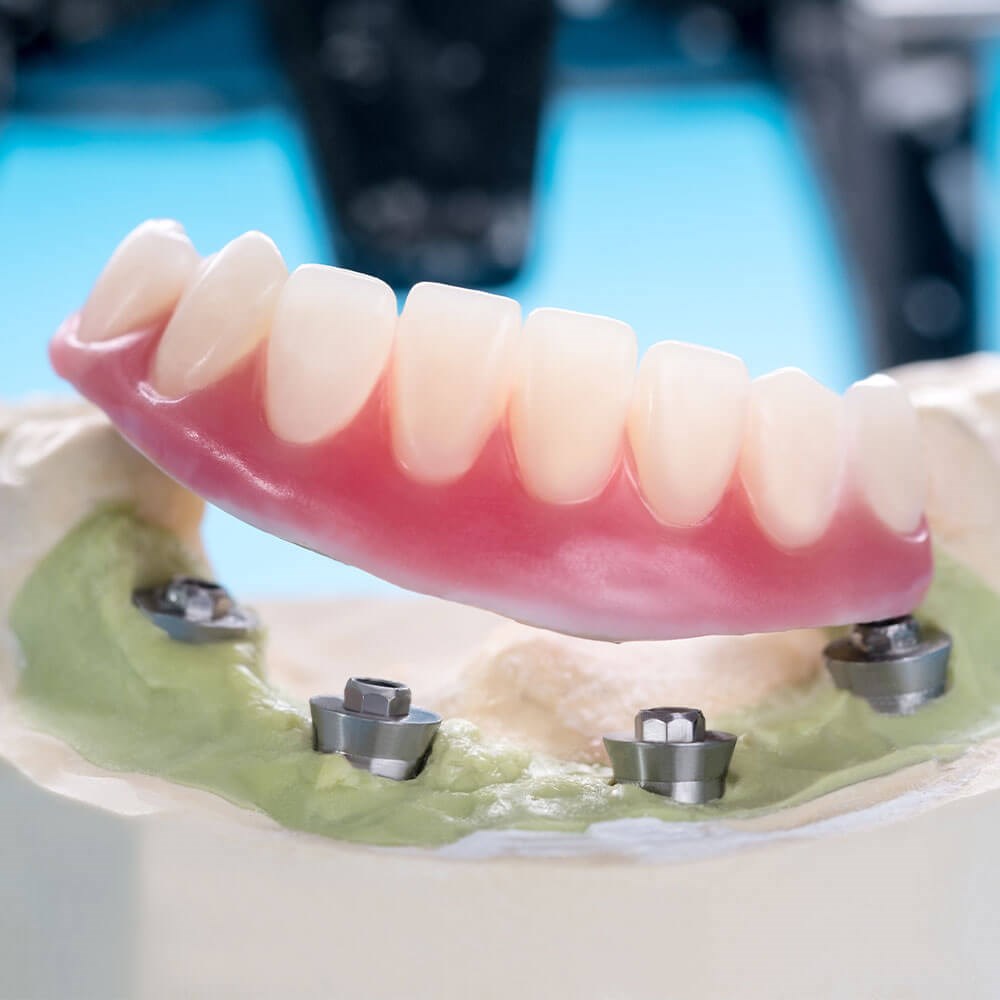 Overdentures