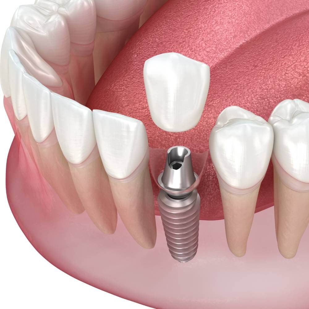 Single Tooth Implant